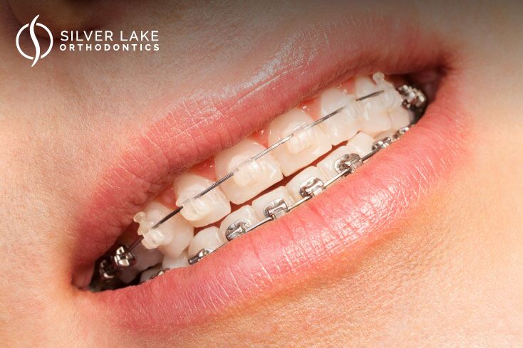 Mentor Invisalign